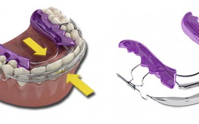 Inman Aligner