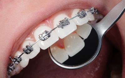 How to survive adult braces