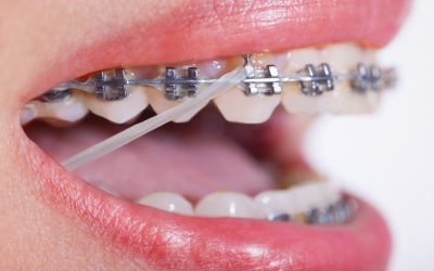Orthodontic patient compliance